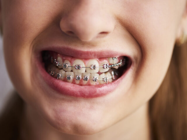 Shot of teeth with braces
